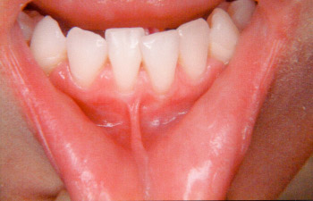 abnormal treatment normal gum teeth between position gap